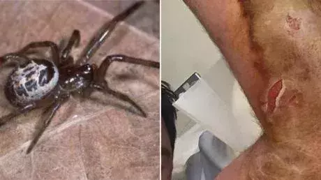 False widow bite