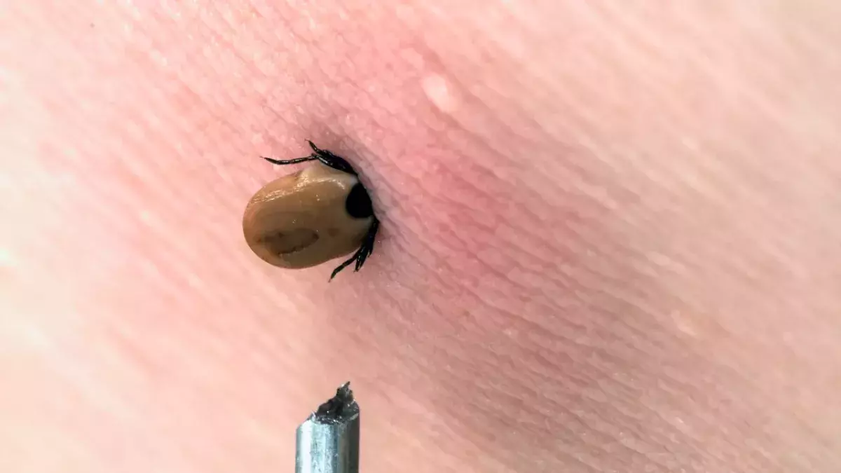 How to react correctly to a tick bite