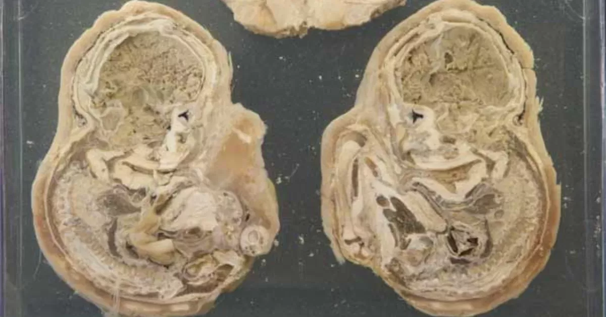 A 75-Year-Old Woman Gave Birth After Being Pregnant For 46 Years