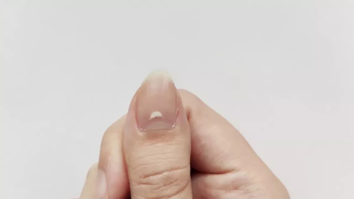 Do you have striated nails? This is what that means