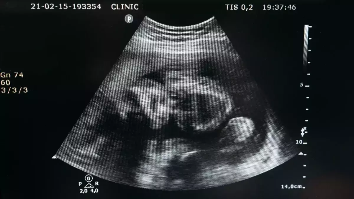 Foetus preggo
