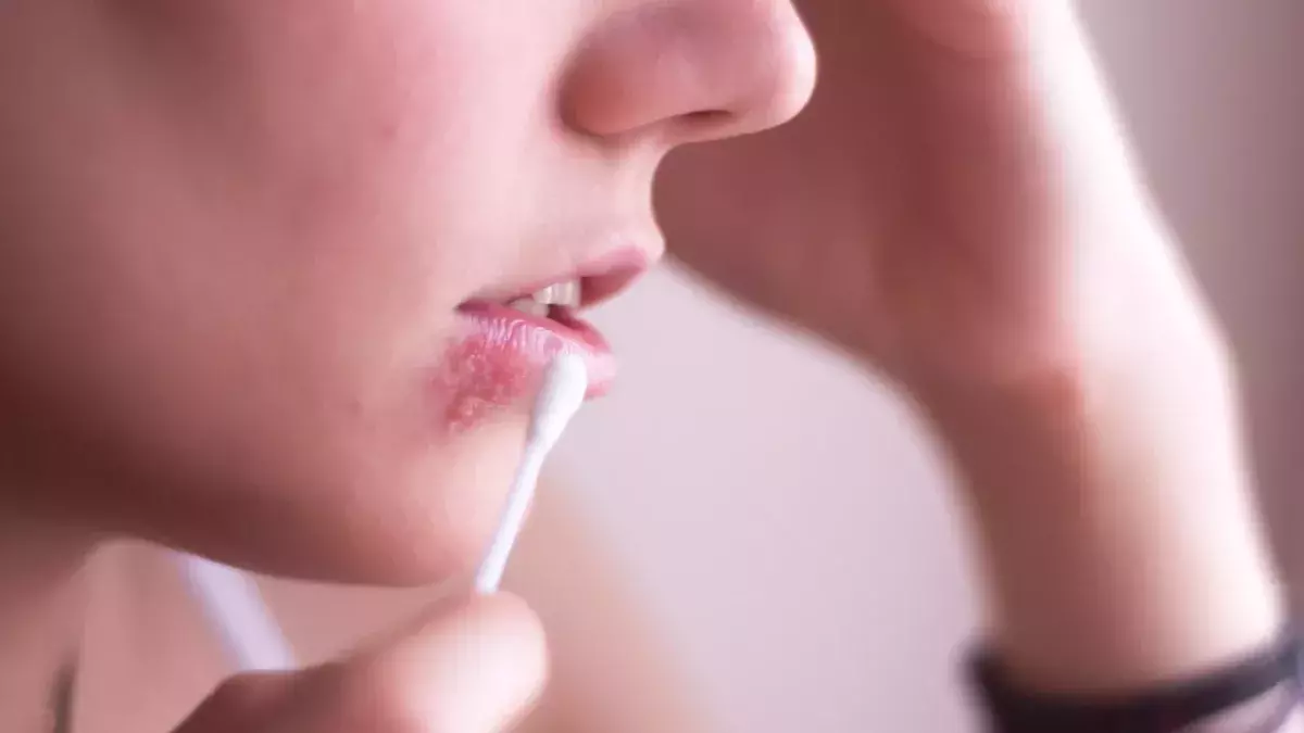 Herpes
