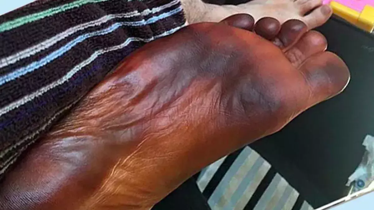 His foot turned black overnight and his wife was to blame!