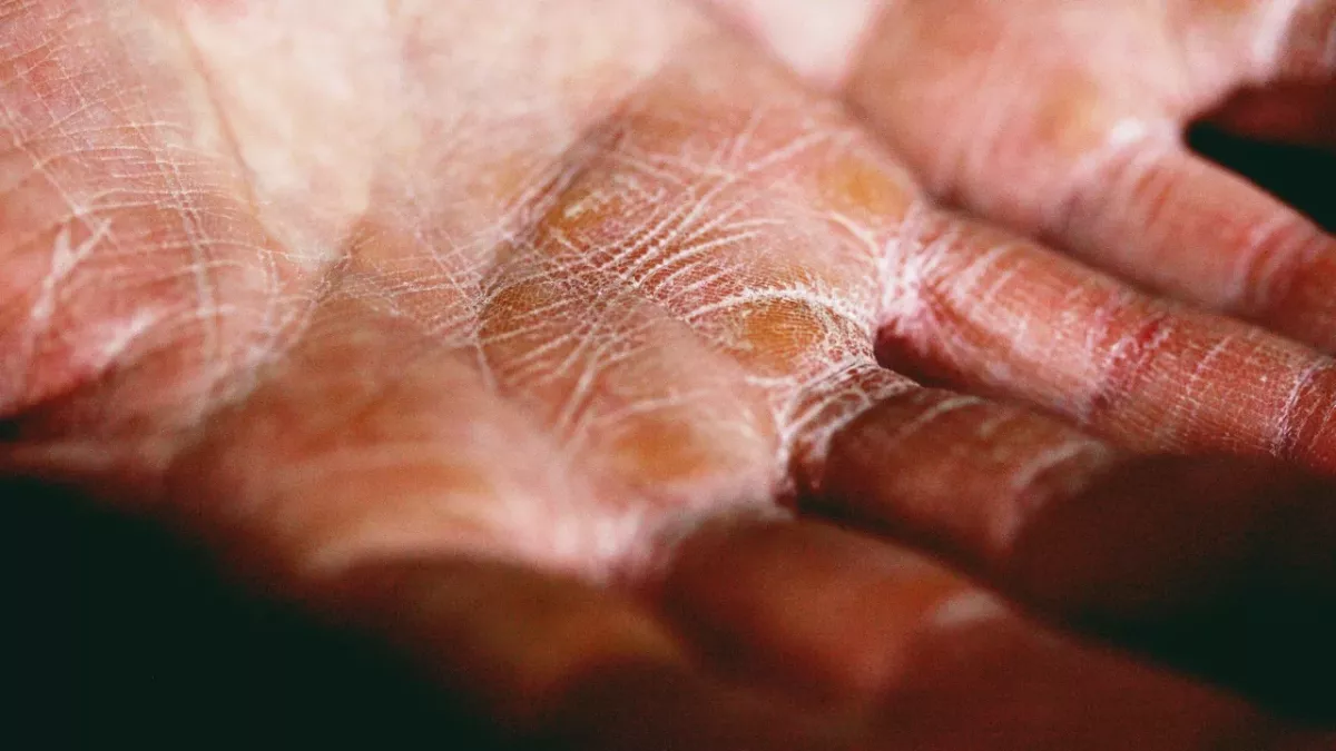 Lupus: 11 symptoms to look out for 