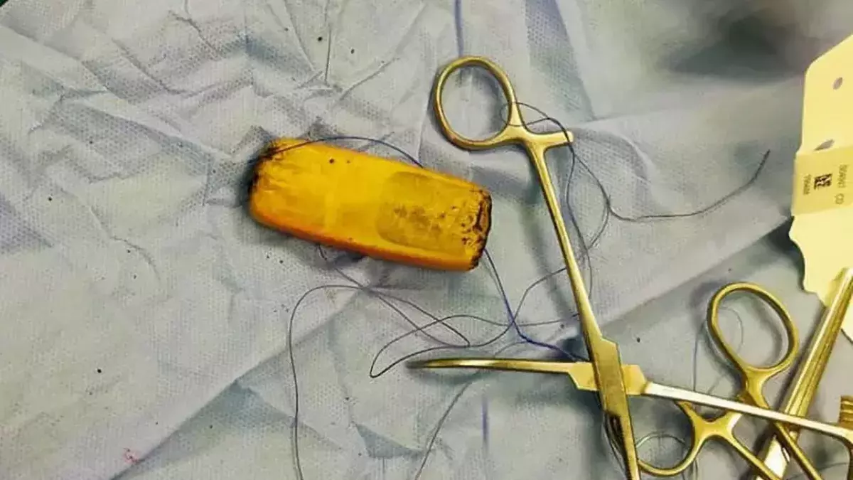 Man swallows entire phone and lived with in stomach for half a year