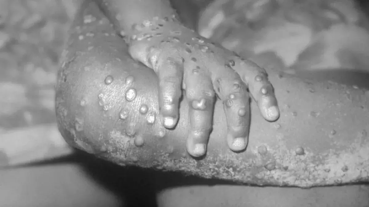 Monkeypox