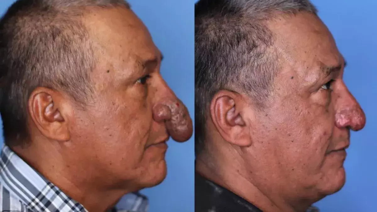 Nose transformation