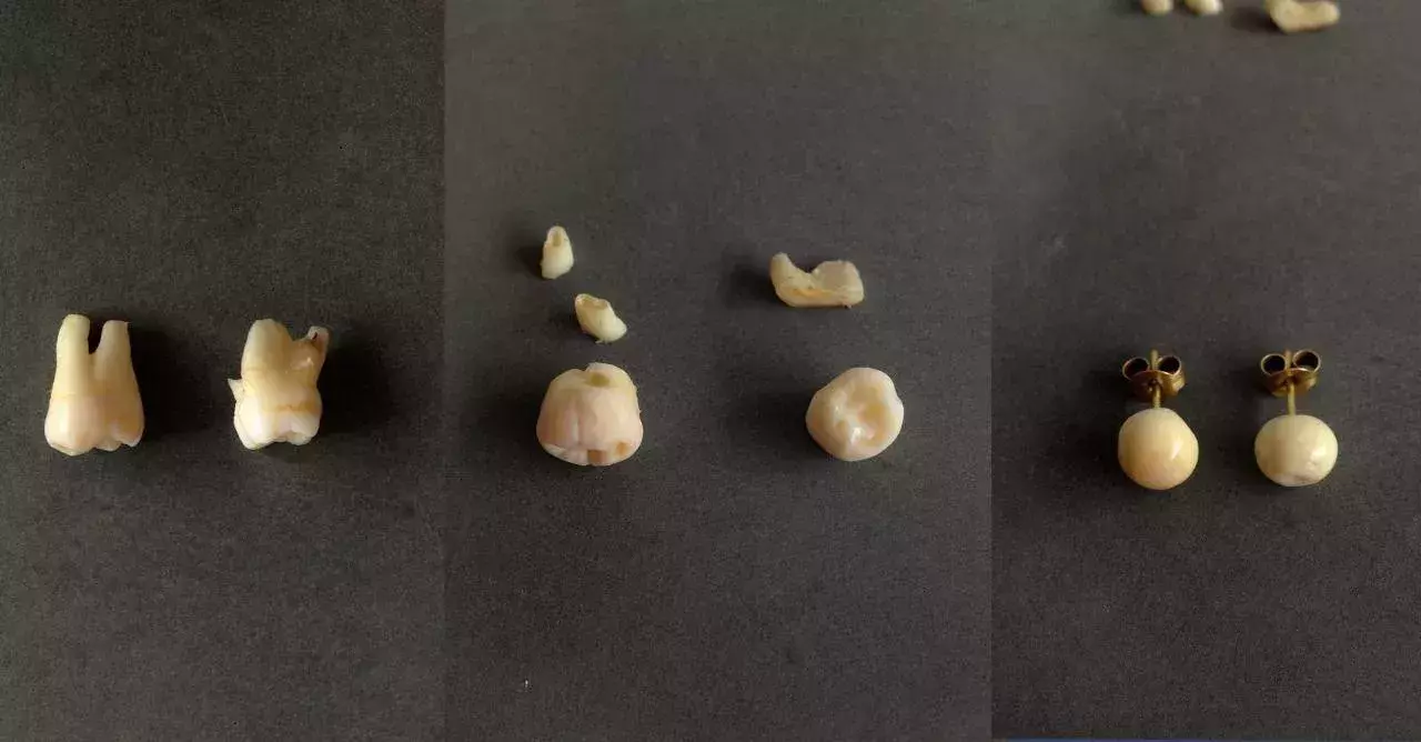 She Made Earrings Out Of Her Wisdom Teeth