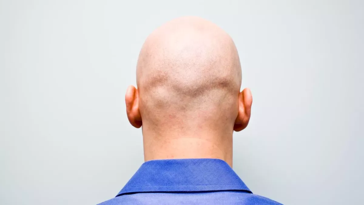 Study Shows Bald Men Are at Higher Risk of Contracting Severe COVID