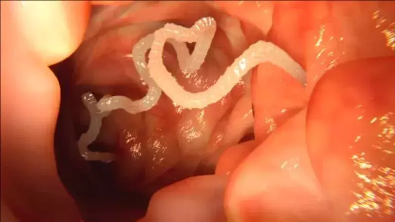 This Thai Man Filmed Himself Pulling A 10-Meter Tapeworm From His Backside