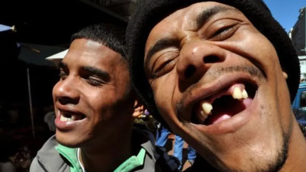 These Men Are Getting Their Front Teeth Pulled in Order to Feel 'More Beautiful'