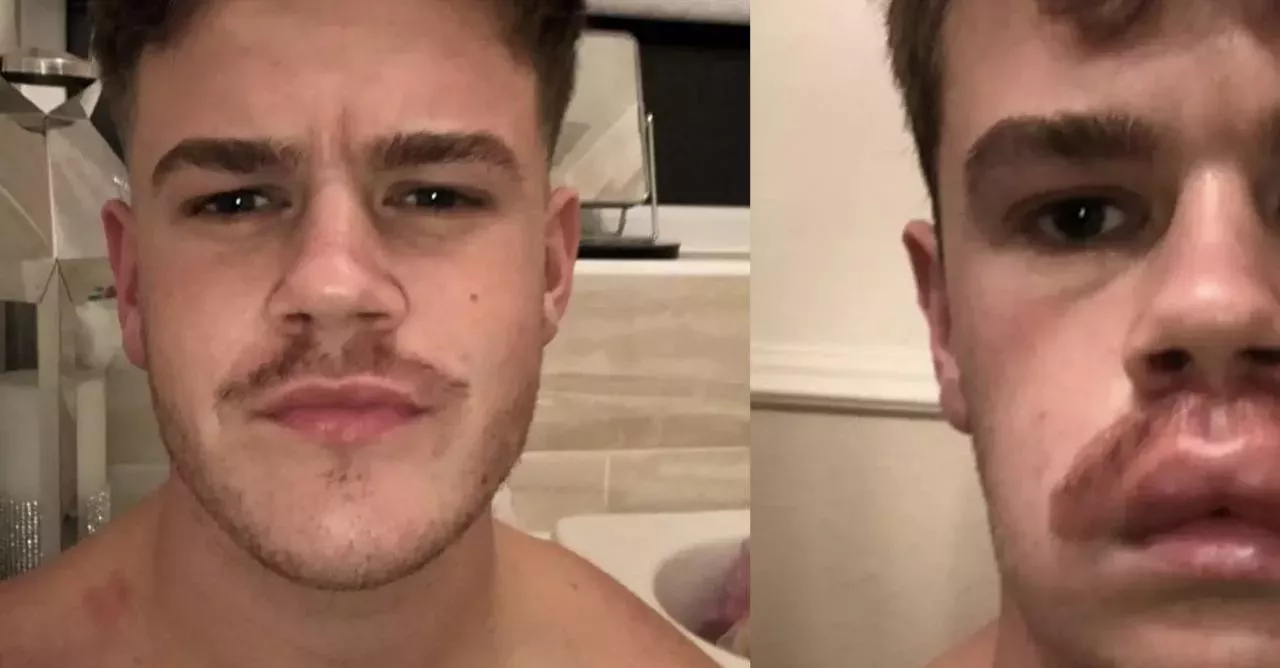 Warns Against Dying Your Mustache For Movember