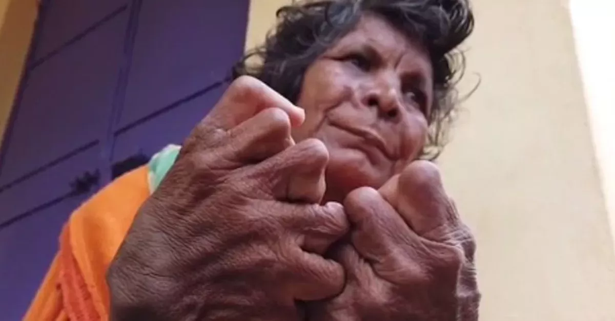  A Woman Who Was Born With 31 Fingers And Toes Set A New Guinness World Record