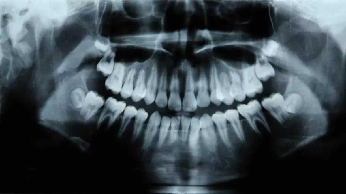 X-ray of mouth