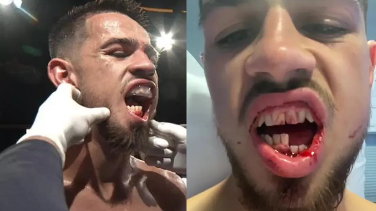 Broken jaw