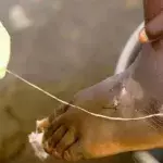 Dracunculiasis