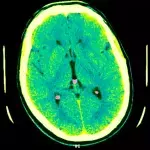 A strange brain disease is on the rise in Canada and has authorities worried