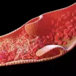 Venous thrombosis, what is it, and do COVID vaccines cause it?