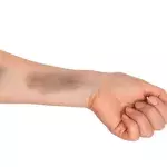 Bruises 