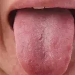 COVID Tongue: The Nasty New Coronavirus Symptom