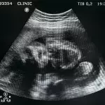 Foetus preggo