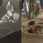 Foot