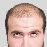 Hair Loss: Can You Fight Against It And Really Eradicate It?