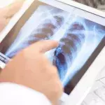 Lung cancer warning signs