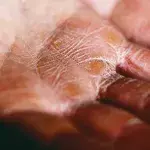 Lupus: 11 symptoms to look out for 