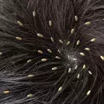 A passenger filmed a woman with a head full of lice