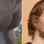 Synthol shooting out of arm