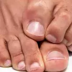 This is why you should never burst a 'pimple' on your feet 