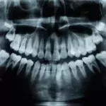 X-ray of mouth