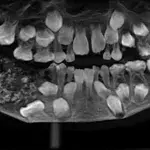 A young boy had 526 teeth removed from his mouth