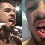 Broken jaw