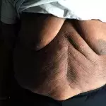 This morbidly obese Youtube stopped eating for 150 days to save his life