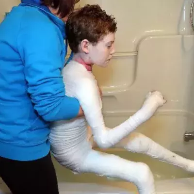 Jonathan Pitre, butterfly child