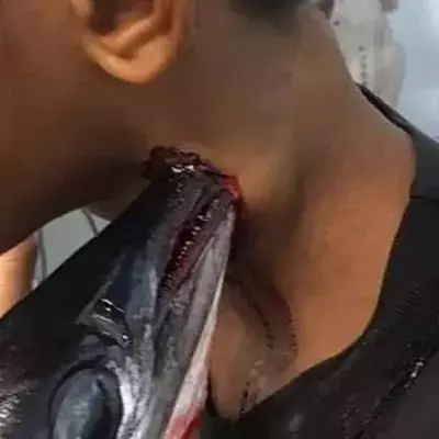 A needlefish attacked Muhammad Idul 