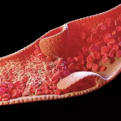 Venous thrombosis, what is it, and do COVID vaccines cause it?