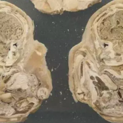 A 75-Year-Old Woman Gave Birth After Being Pregnant For 46 Years