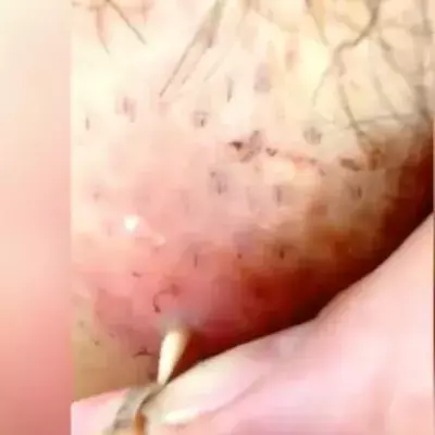 Botfly
