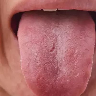 COVID Tongue: The Nasty New Coronavirus Symptom