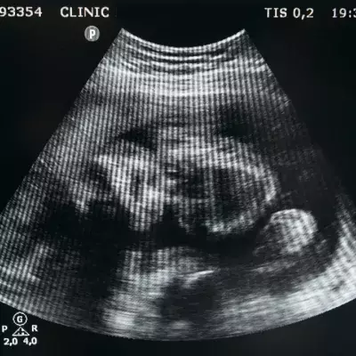 Foetus preggo