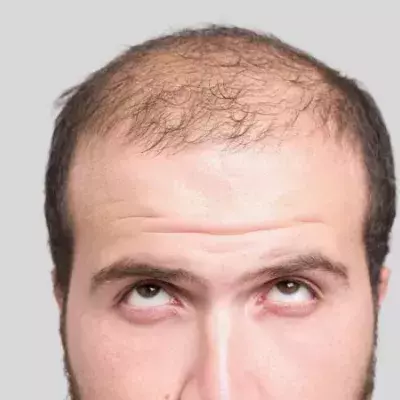 Hair Loss: Can You Fight Against It And Really Eradicate It?