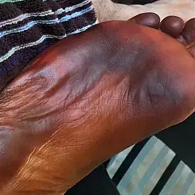His foot turned black overnight and his wife was to blame!