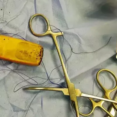 Man swallows entire phone and lived with in stomach for half a year