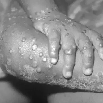 Monkeypox