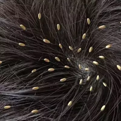 A passenger filmed a woman with a head full of lice