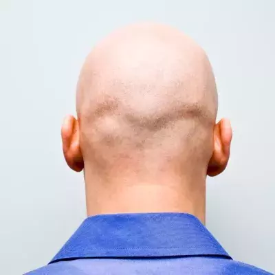 Study Shows Bald Men Are at Higher Risk of Contracting Severe COVID