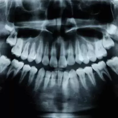 X-ray of mouth